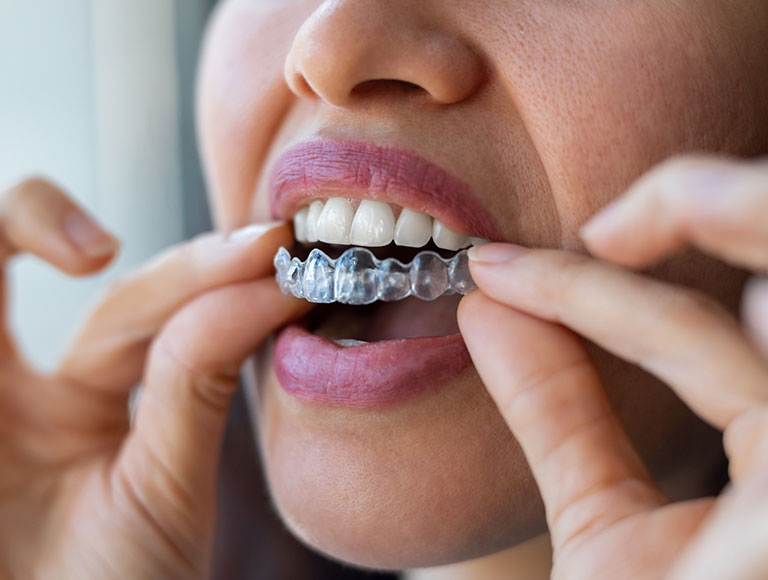 Book Your Invisalign Consultation Today